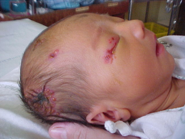 A number of babies have contracted herpes from the penis sucking ritual. In several cases this has lead to brain damage and even death.