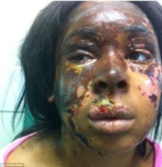 Naomi Oni (pictured) had sulphuric acid thrown on her in an attack inspired by the assault of Katie Piper Naomi Oni (pictured) had sulphuric acid thrown on her in an attack inspired by the assault of Katie Piper