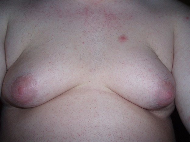 29889gynecomastia_large 29889gynecomastia_large