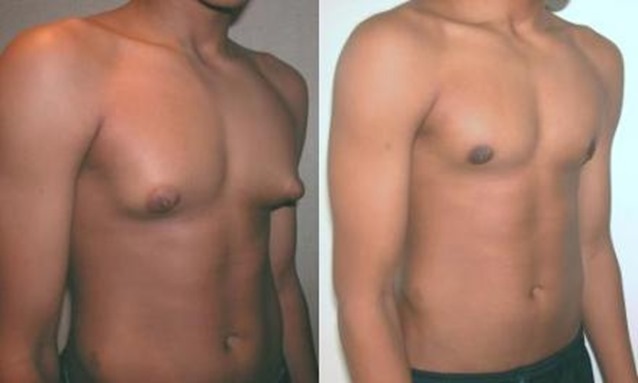 29889gynecomastia 29889gynecomastia