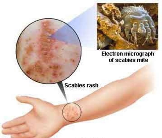 scabies-mite-image-2
