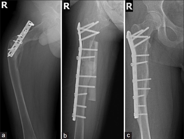 IndianJOrthop_2013_47_4_377_114922_f3