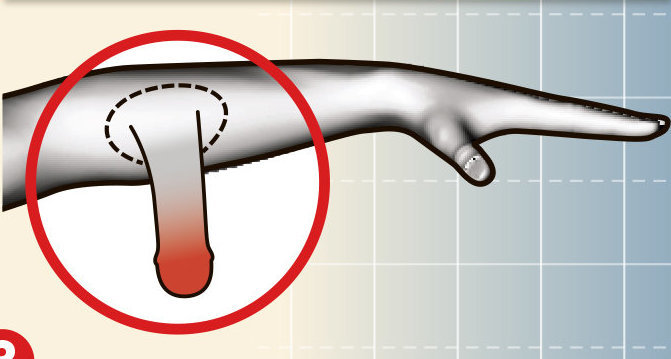 Man has had a Penis Growing Out of His Arm for the Last Four Years