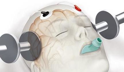 UK: Patients Sue NHS After Getting Brain Damage from Depression Treatment