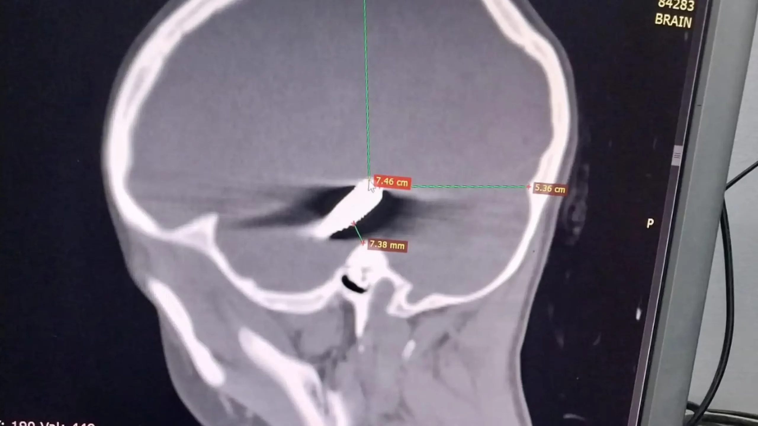 Israeli Snipers are Targeting Children, Doctors Warn