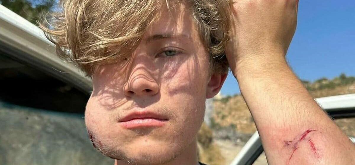 West Bank: Jew Settlers Beat Up White People Helping the Palestinians